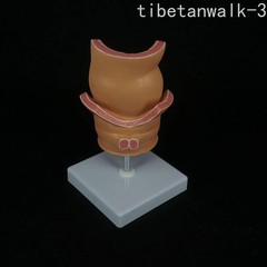 Anatomical Human Rectum Pathology Lesion Model Hemorrhoids Anus Rectal