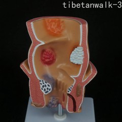 Anatomical Human Rectum Pathology Lesion Model Hemorrhoids Anus Rectal