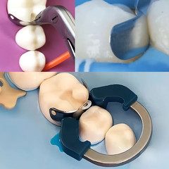 Dental Sectional Matrix Bands with Niti Clamps For Rubber Dam Autoclavable 135°C